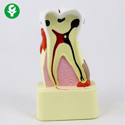 Çürük Karşılaştırma Diş Diş Modeli / Öğretim İçin Diş Gösterme Modelleri